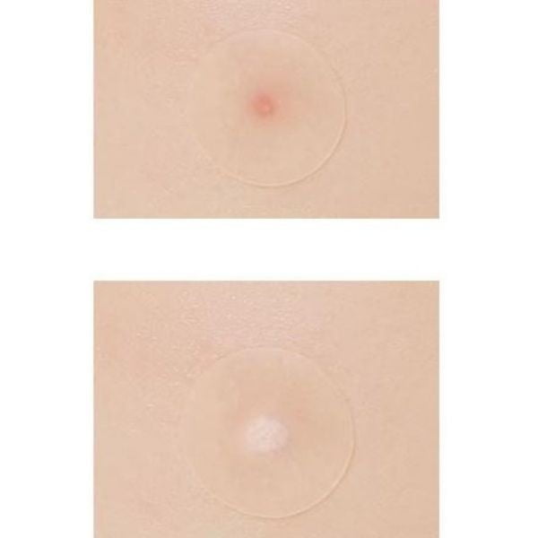 A'pieu Fusidium Clear Spot Patches - Missha Middle East