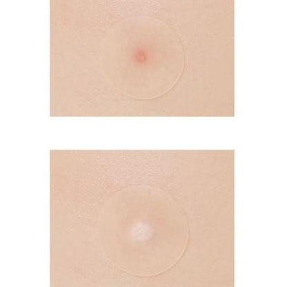A'pieu Fusidium Clear Spot Patches - Missha Middle East